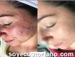 Eliminación del acné